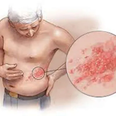 Опоясывающий лишай - Консультация Дерматолога Онлайн