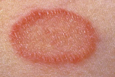 Розовый лишай, или лишай Жибера: фото, заразен ли, лечение