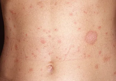 Некоторые кожные болезни: отрубевидный и розовый лишай