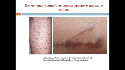 Красный плоский лишай — Курсы по дерматоскопии | Юрий Сергеев