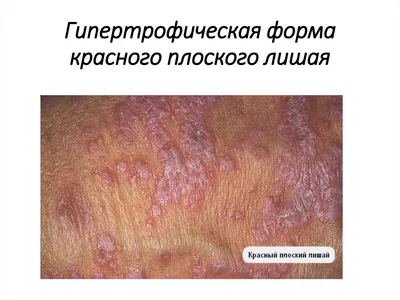 Аллергический дерматит стоковое фото. изображение насчитывающей обработка -  50773670