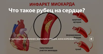 Что такое рубец на сердце? | Анна Кореневич | Врач-кардиолог | Клинический  психолог | Дзен