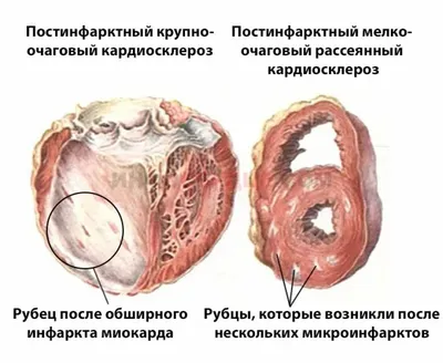 Инфаркт миокарда: острый, обширный и пр.; симптомы и лечение