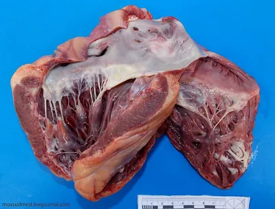 Инфаркт миокарда: как выглядит, что значит инфаркт сердца