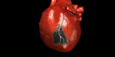 Инфаркт миокарда - причины появления, симптомы заболевания, диагностика и  способы лечения