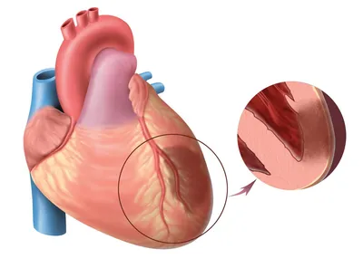 8 признаков инфаркта миокарда, при которых нужно звонить в скорую -  Лайфхакер