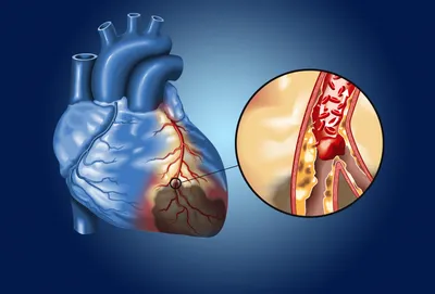 Инфаркт миокарда: симптомы, лечение, признаки острого инфаркта миокарда,  формы и диагностика