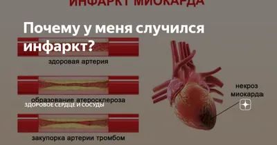 Найден способ полностью восстановить сердце после инфаркта - РИА Новости,  29.09.2019