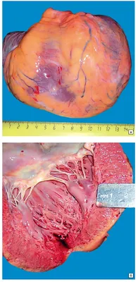 Сердце — не игрушка: что может привести к инфаркту-миокарда