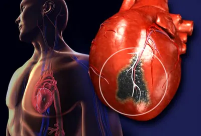 Причины, симптомы и последствия «мужского» инфаркта | Медицинский центр  \"Новая медицина\"