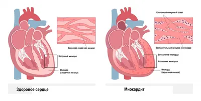Инфаркт миокарда: история болезни, причины и симптомы