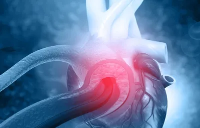 Кардиолог Бокерия: «разрыв сердца» может произойти после инфаркта