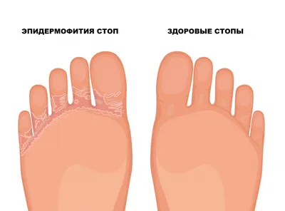 Руброфития – симптомы и лечение: опытный дерматолог в Москве.