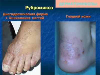 Грибковые заболевания кожи - презентация онлайн
