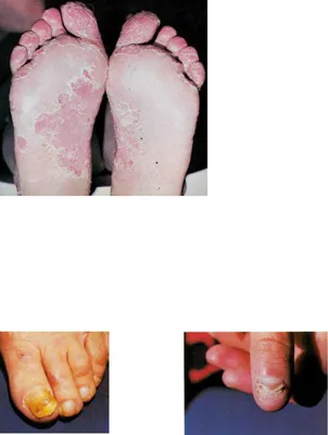 Лекция № 6 для студентов педиатрического факультета Грибковые заболевания  кожи - презентация, доклад, проект