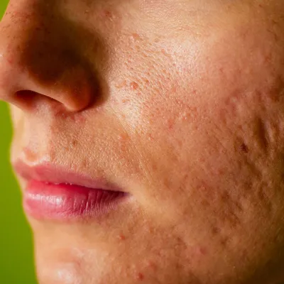 Косметология. Борьба с рубцами постакне и застойными пятнами на лице |  Пикабу