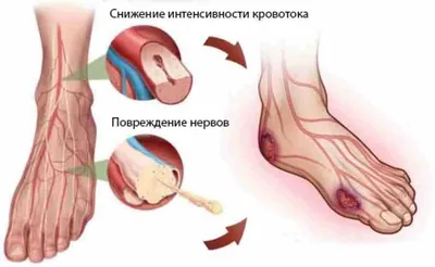 Сахарный диабет: взгляд хирурга ✓ Авторские статьи Клиники подологии Полёт  в Москве
