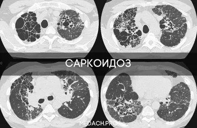 Проблемы дифференциальной диагностики саркоидоза | Інтернет-видання \"Новини  медицини та фармації\"