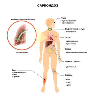 Увеит при саркоидозе - online presentation