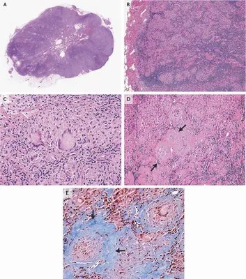 Глазной саркоидоз: klinicheskoe issledowanie i diagnosticheskaq  naprawlennost' | Amazon.com.br