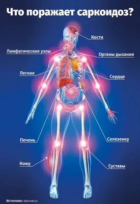 Саркоидоз: симптомы, причины, диагноз и лечение