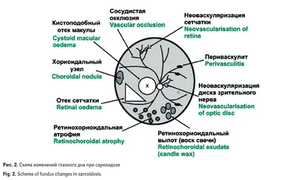 Сравнительная оценка разных режимов лечения саркоидоза: анализ реальной  клинической практики - Визель - Consilium Medicum