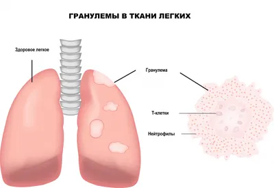 Лечение саркоидоза легких в Москве - МУ \"Поликлиника ФНПР\"