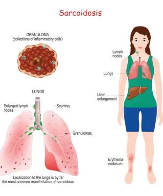 Саркоидоз