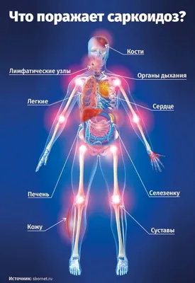 Саркоидоз (болезнь Бенье-Бека-Шаумана) - причины появления, симптомы  заболевания, диагностика и способы лечения