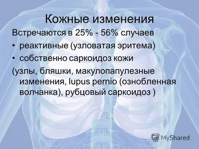 Саркоидоз: введение в проблему и история учения – тема научной статьи по  клинической медицине читайте бесплатно текст научно-исследовательской  работы в электронной библиотеке КиберЛенинка