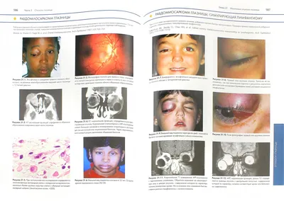 Иллюстрация 1 из 1 для Опухоли век, конъюнктивы и глазницы. Атлас и  справочник. В 2-х томах. Том 2 - Шилдс, Шилдс | Лабиринт - книги. Источник:  Лабиринт