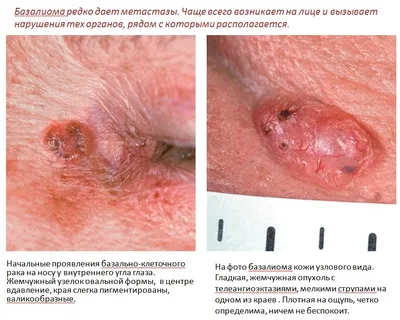 Ранний базальноклеточный рак кожи.: dr_jamais — LiveJournal
