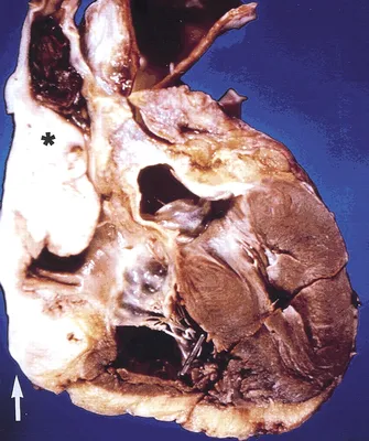 Онкология. ОГК. Опухоли сердца. + | Портал радиологов
