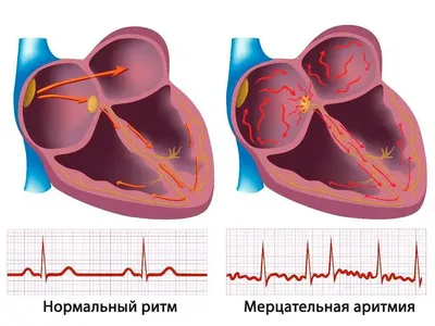 Злокачественная опухоль сердца дала метастаз в головной мозг » ФГБУ «НМИЦ  им. В. А. Алмазова» Минздрава России