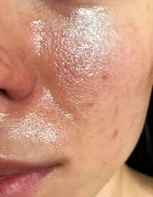 Себорейный дерматит на лице – крем и мази для лечения, жирная себорея кожи  лица