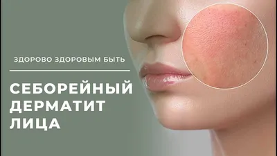 Себорейный дерматит: причины, диагностика, лечение | Портал 1nep.ru