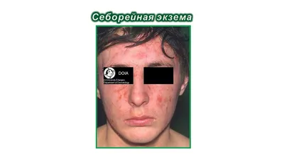 Себорейный дерматит: все, что нужно знать - Клиника Гарант - г. Нижний  Новгород