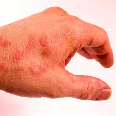 Микробная экзема: фото, лечение, причины. Аллергия на солнце (краснуха) |  Интернет-журнал Estetmedicina.ru