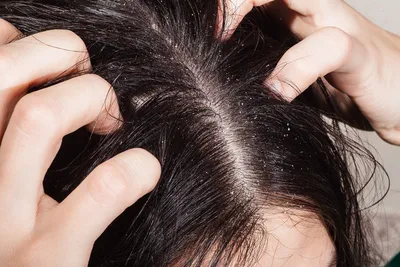 Себорея кожи головы и выпадение волос у женщин