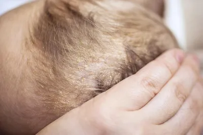 Псориаз волосистой части головы: причины, как выглядит, что делать, лечение