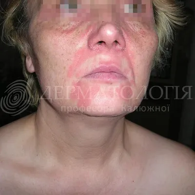 себорейный дерматит на коже головы ребенка Стоковое Фото - изображение  насчитывающей дерматология, лосьон: 218760684