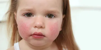 Себорейный дерматит: на лице, коже головы, лечение у взрослых и детей