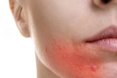 Себорейный дерматит на лице: как избавиться от косметического дефекта |  ESTET-PORTAL | Дзен