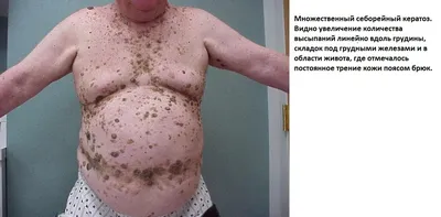 Удаление лазером папиллом и кератом на лице, шее и теле в московской  клинике лазерной хирургии «Вектор»
