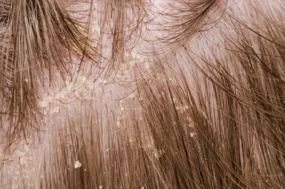 ✓Себорейный дерматит— распространенное хроническое заболевание кожи,  богатой сальными железами ( волосистая часть головы, лицо, кожные  складки).... | By On Clinic Bishkek | Facebook