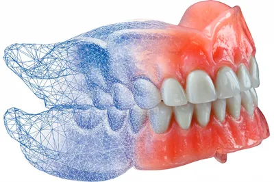 Новое поколение зубных протезов без неба: виды, фото и отзывы -  Стоматология Эспадент