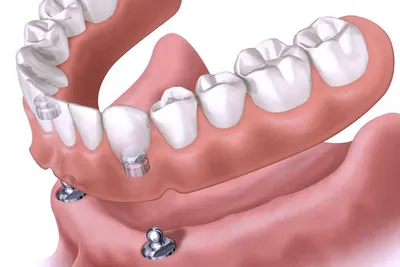 Съемные зубные протезы: цена в Москве на протезирование в клинике  стоматологии, изготовление и установка на челюсть