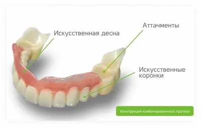 Силиконовый зубные протезы на верхнюю и нижнюю челюсть — цена в Москве