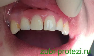 Съемное протезирование зубов в Саратове - Твой Стоматолог
