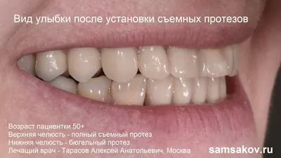 Частичные съемные зубные протезы на нижнюю и верхнюю челюсть, стоимость  частичного съемного протеза в Люблино